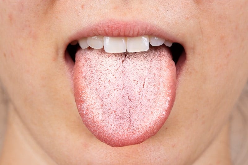 Dame med tungen full av sopp